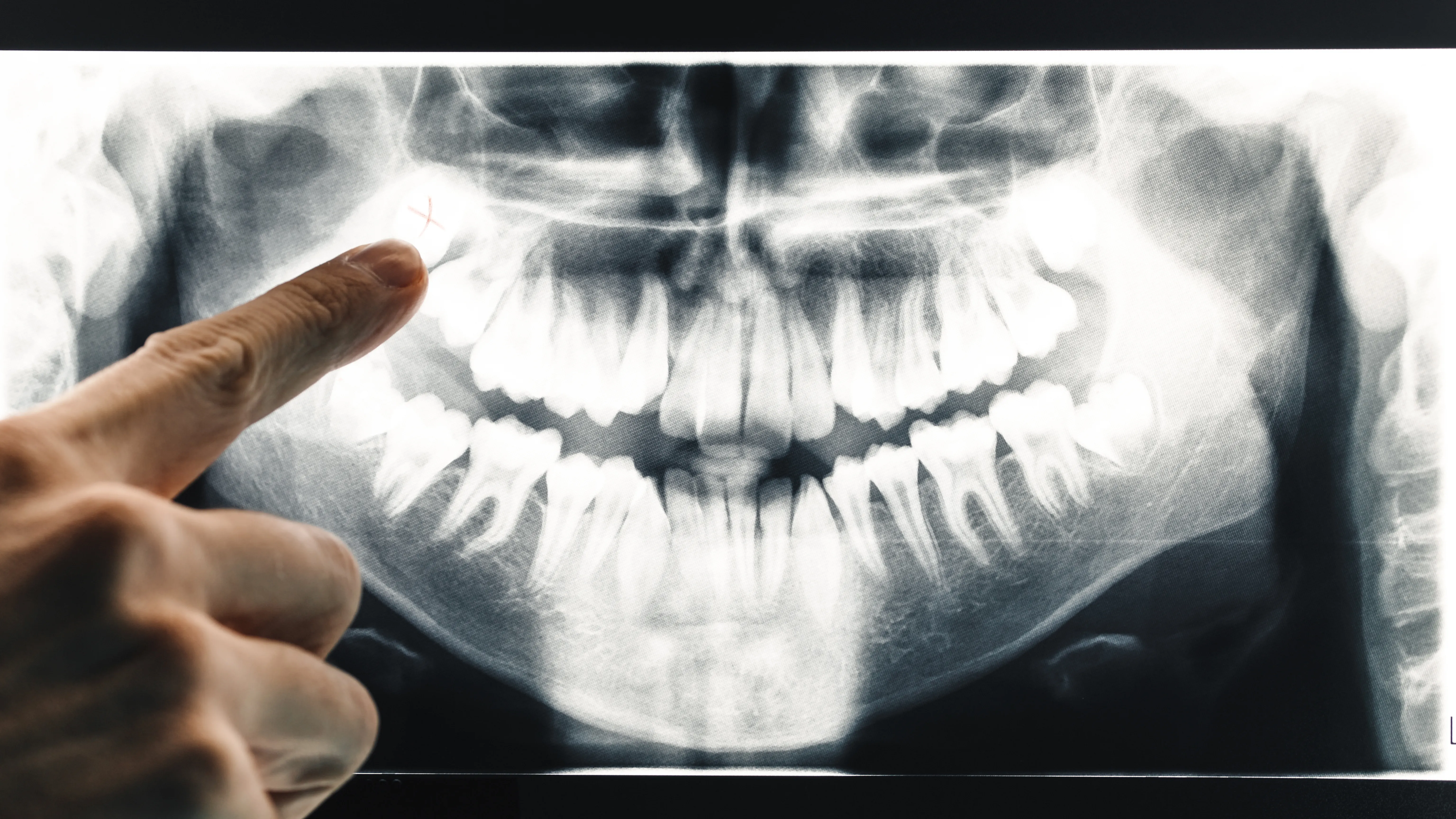 Imagen panorámica dental donde se observan maxilares completos y diversos tipos de radiografías dentales para diagnóstico integral.